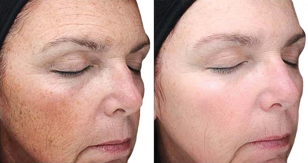 VI Peel, before and after